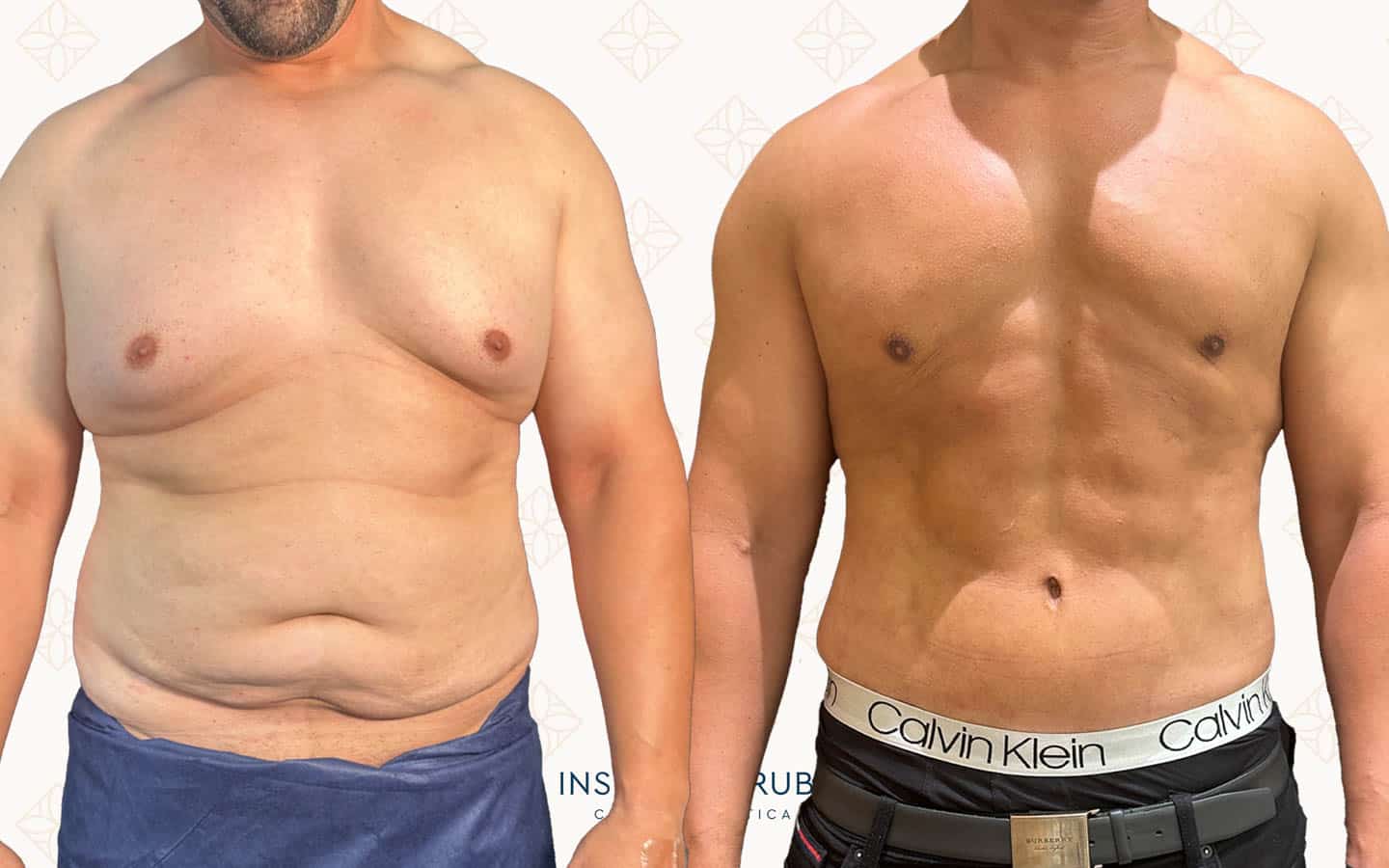 Resultado de abdominoplastia de frente: abdomen plano y cintura definida