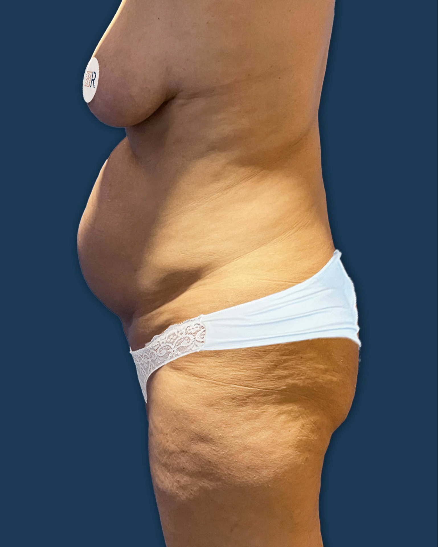 Antes de mommy makeover: abdominoplastia y cirugía mamaria en Instituto Rubí