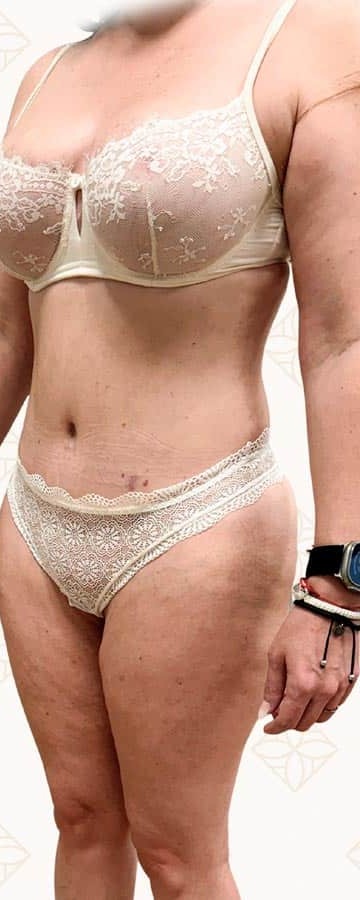 Después de abdominoplastia tras pérdida de peso importante en Instituto Rubí