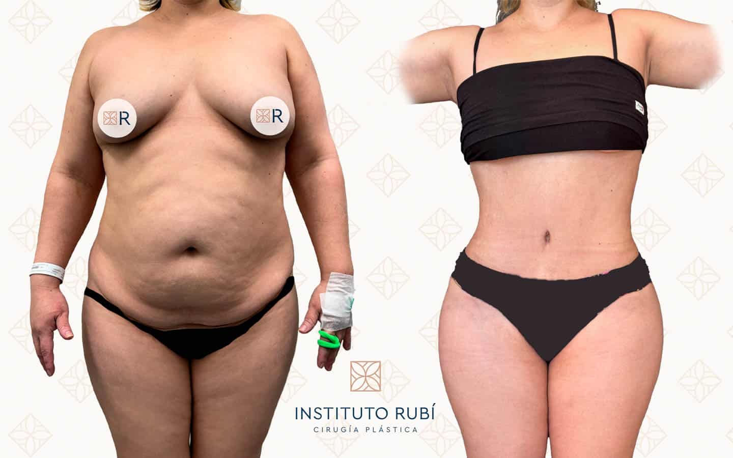Resultado de lipoabdominoplastia de frente en paciente de Instituto Rubí