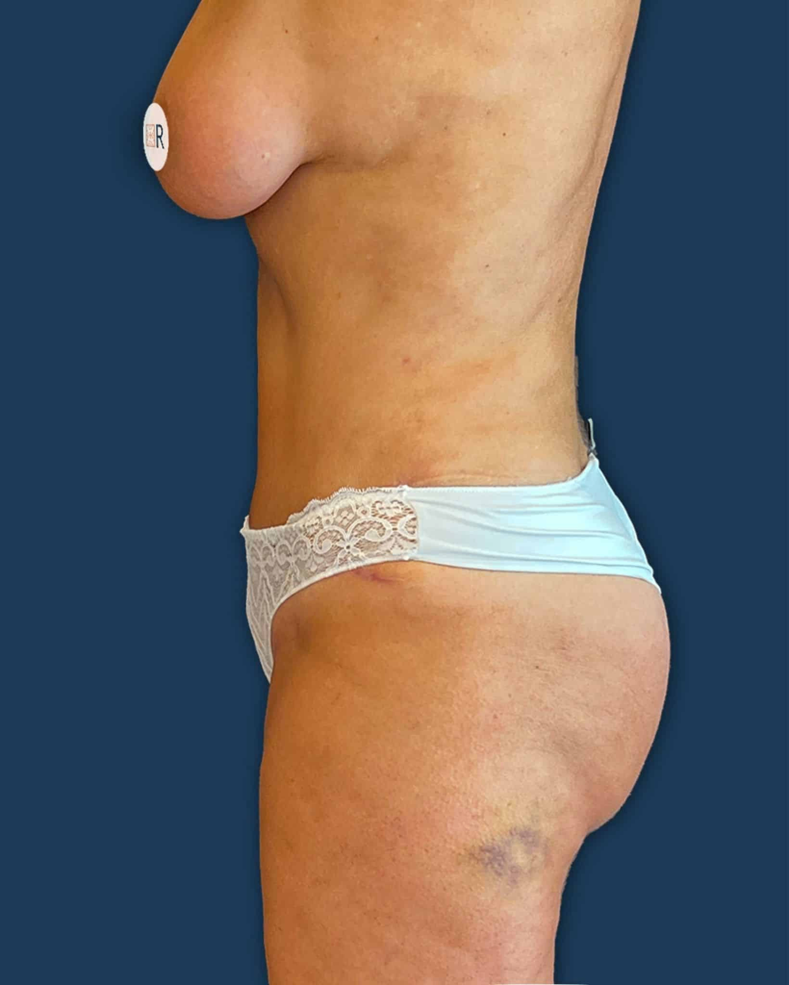 Después de mommy makeover: abdominoplastia y cirugía mamaria en Instituto Rubí