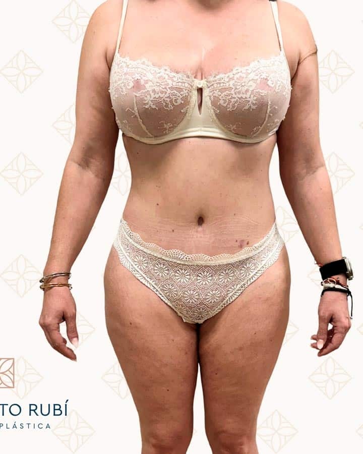 Después de mini abdominoplastia con liposucción de abdomen inferior en Instituto Rubí