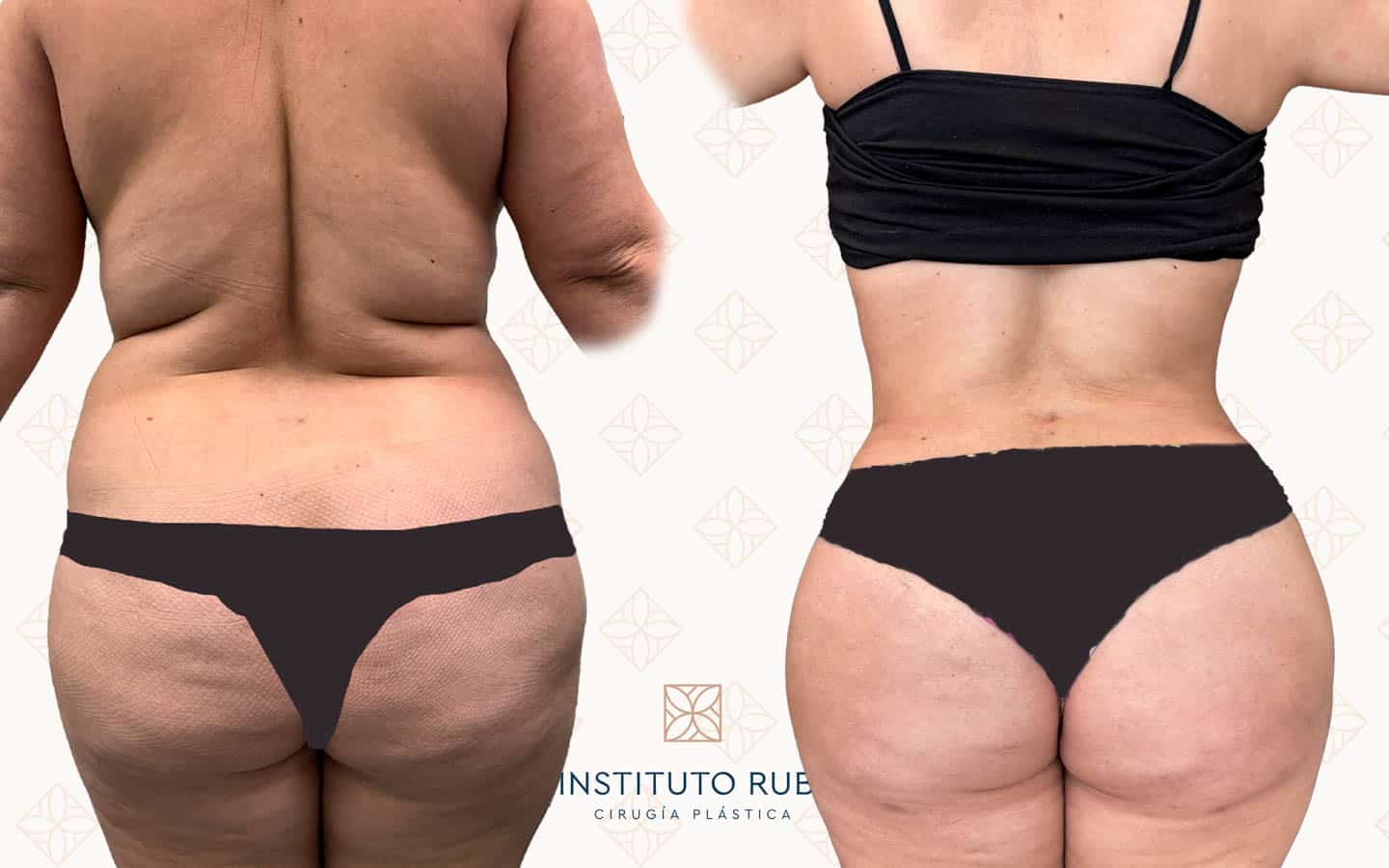Resultado de abdominoplastia y lipoescultura 360 de espalda