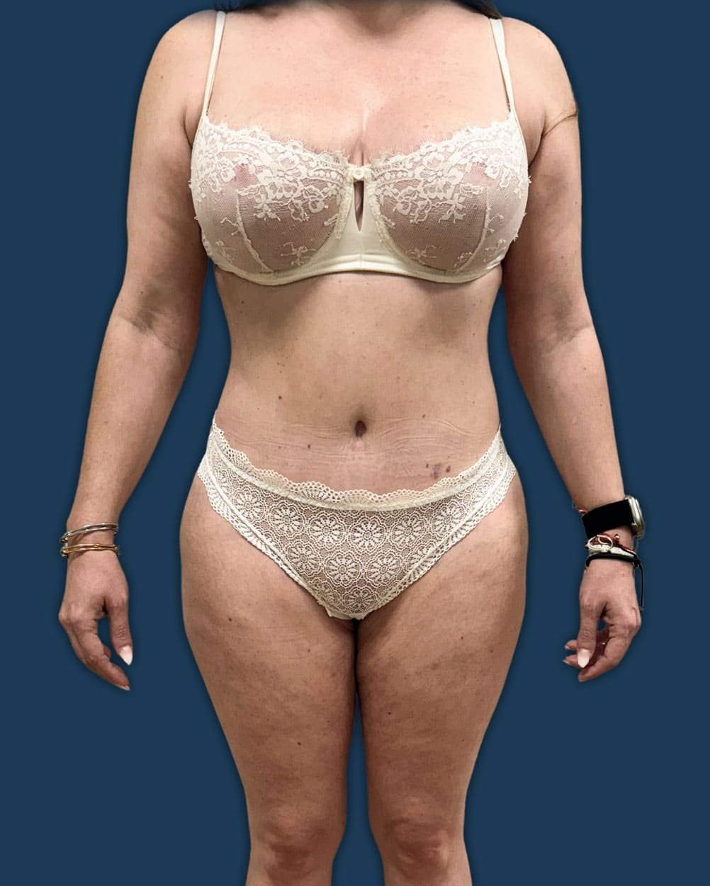 Después de abdominoplastia con plicatura de rectos tras dos embarazos en Instituto Rubí