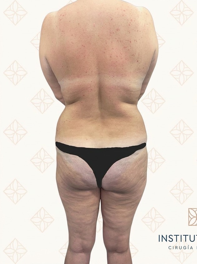 Antes de lipoabdominoplastia con vaser 360 de cintura y flancos en Instituto Rubí