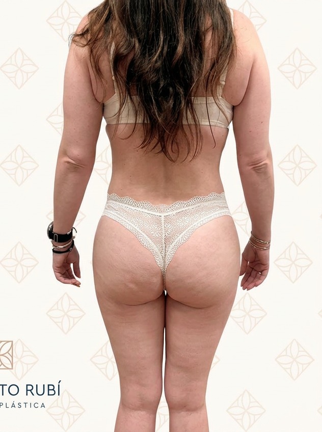 Después de lipoabdominoplastia con vaser 360 de cintura y flancos en Instituto Rubí