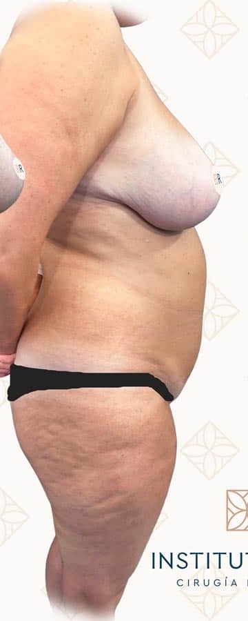 Antes de abdominoplastia y remodelación de la cintura en Instituto Rubí