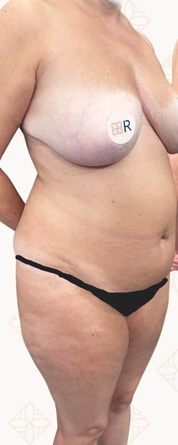 Antes de abdominoplastia tras pérdida de peso importante en Instituto Rubí