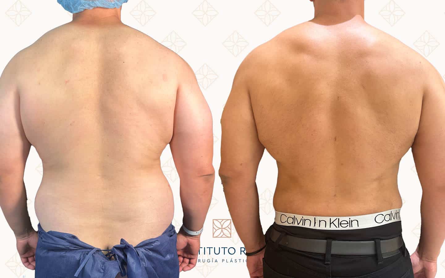 Contorno posterior tras abdominoplastia con lipoescultura VASER 360