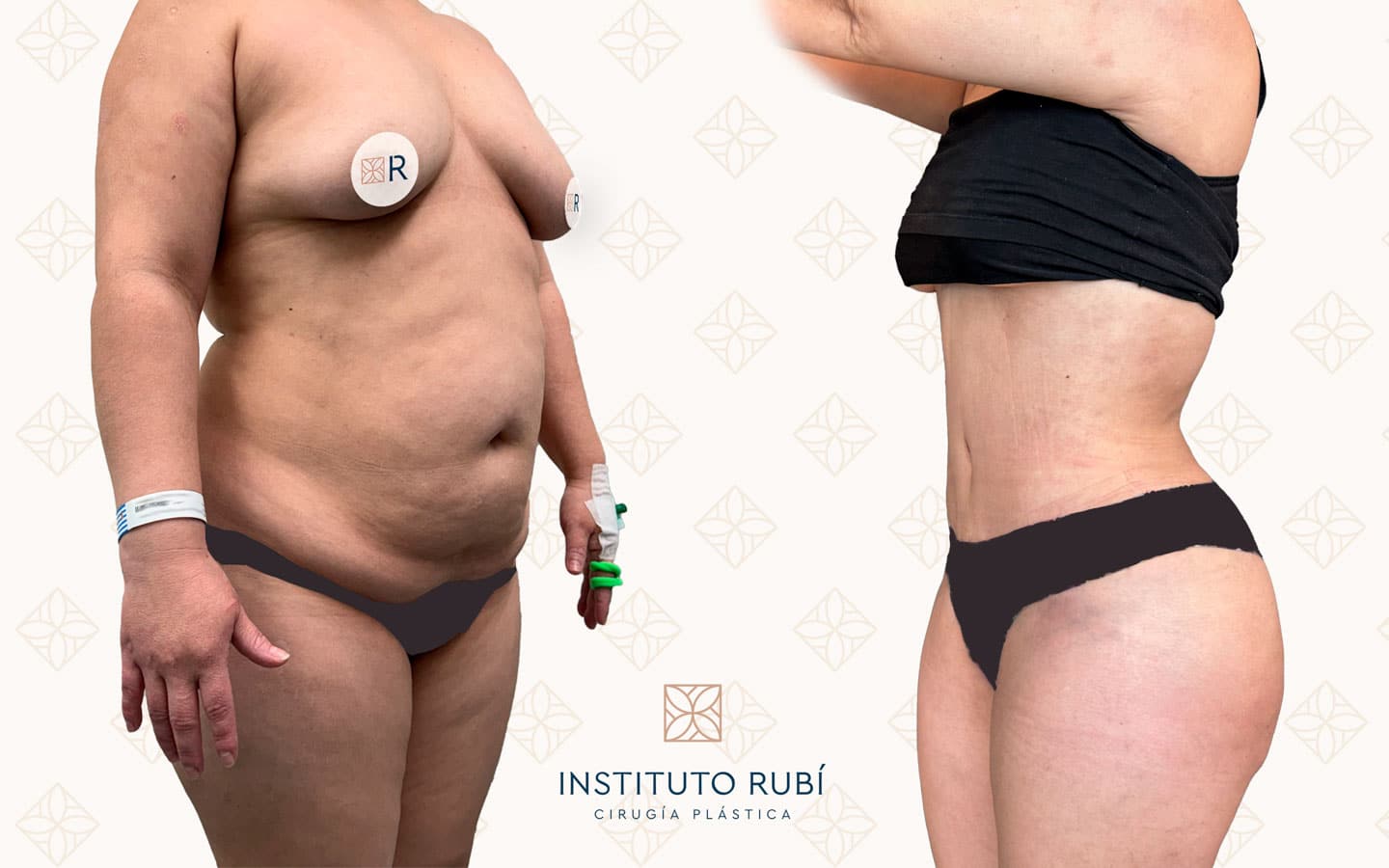 Resultado de abdominoplastia de perfil con contorno abdominal firme